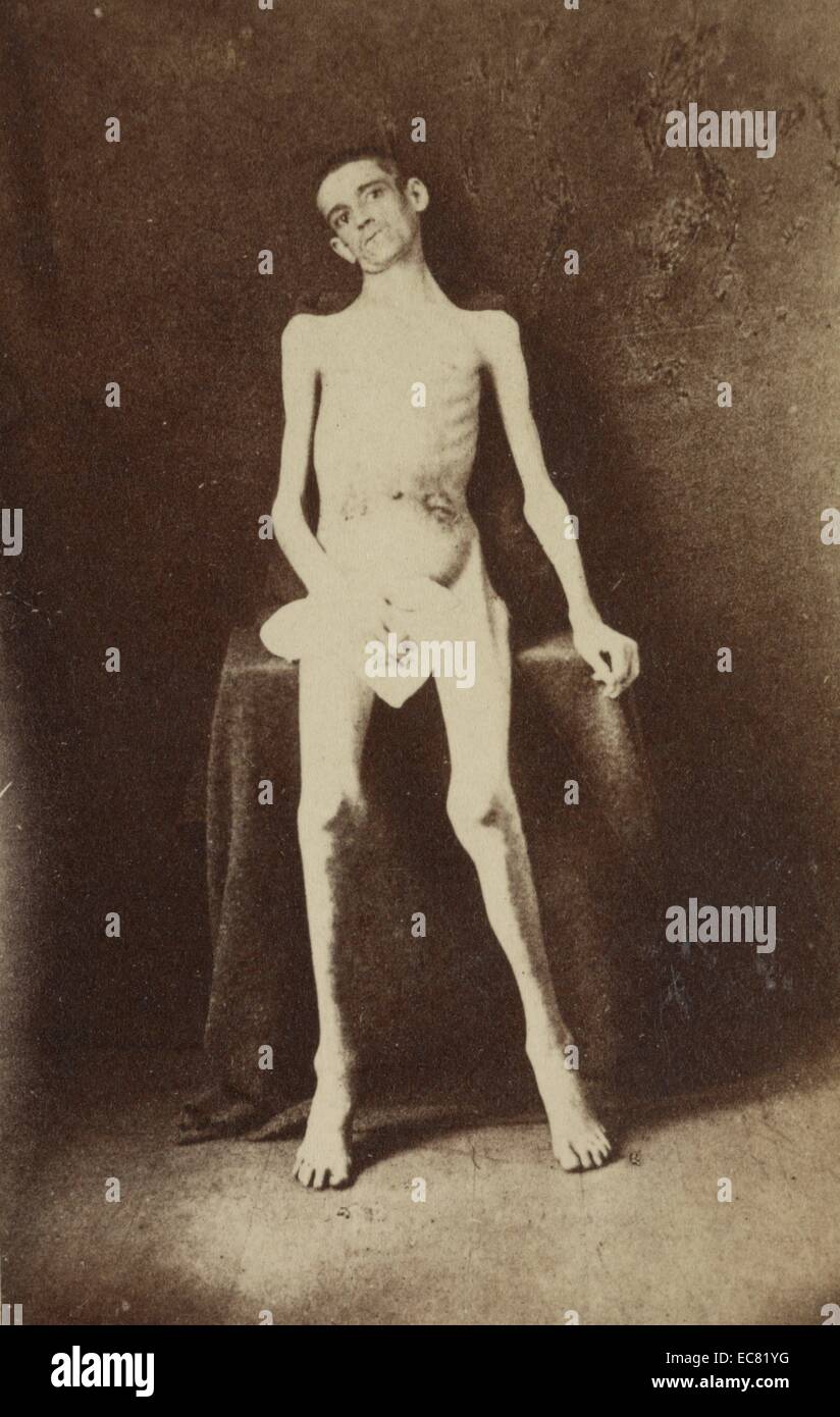 American Civil War soldier malnourished as a prisoner of war. Pvt. William M. Smith, Co. D, 8th Kentucky Vols. at U.S. General Hospital, Div. No. 1, Annapolis, Maryland, June 1, 1864 Stock Photo