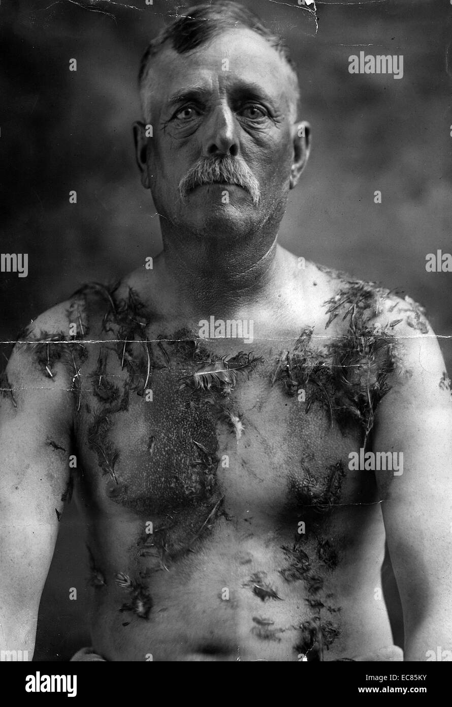 Photograph of John Meints, a German-American farmer who suffered these injuries during World War I. John Meints was tarred and feathered in Minnesota during WW1 (ca 1917-18) for not supporting war bond drives. Dated 1920. Stock Photo