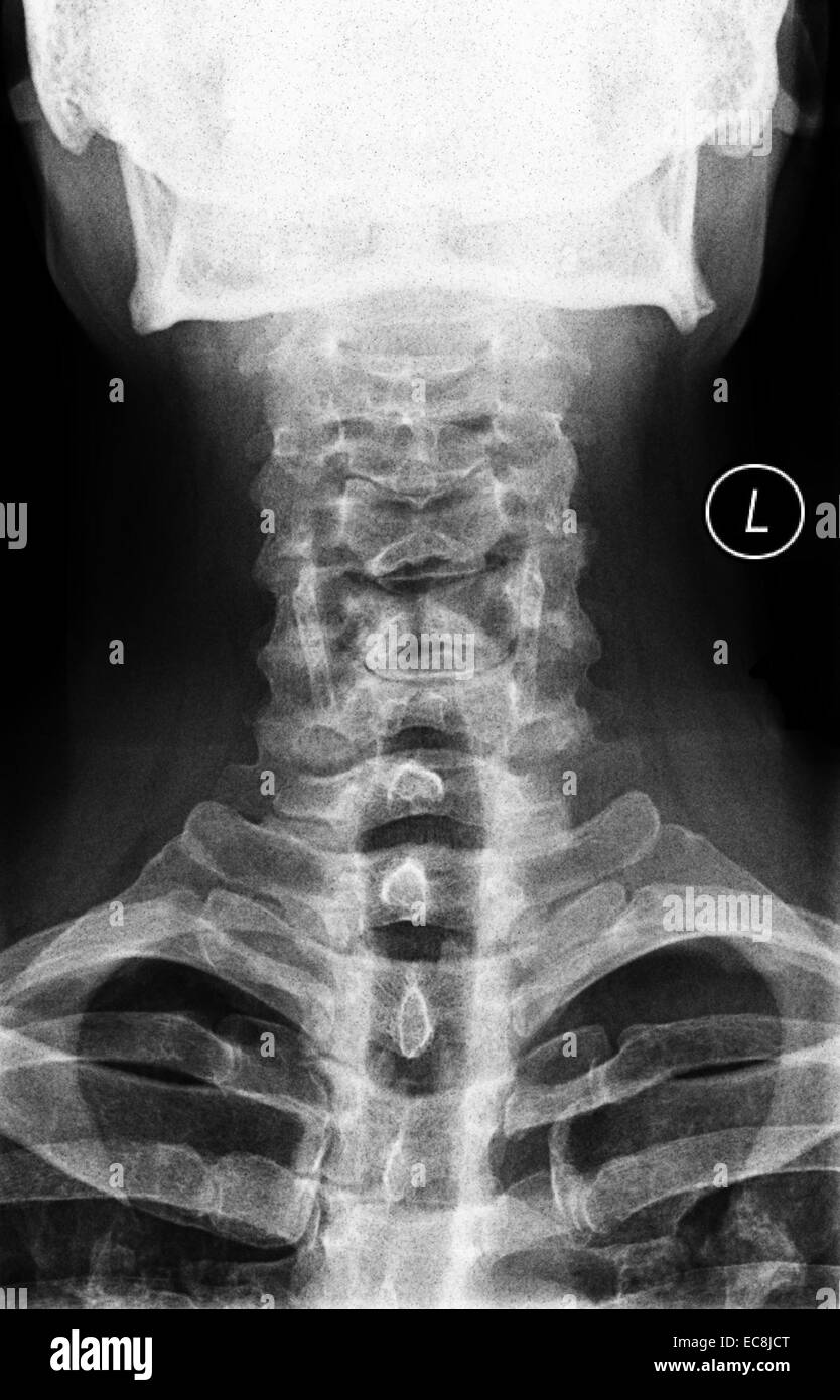 neck x-ray of cervical vertebrae, medial view, 40 year old male, normal Stock Photo
