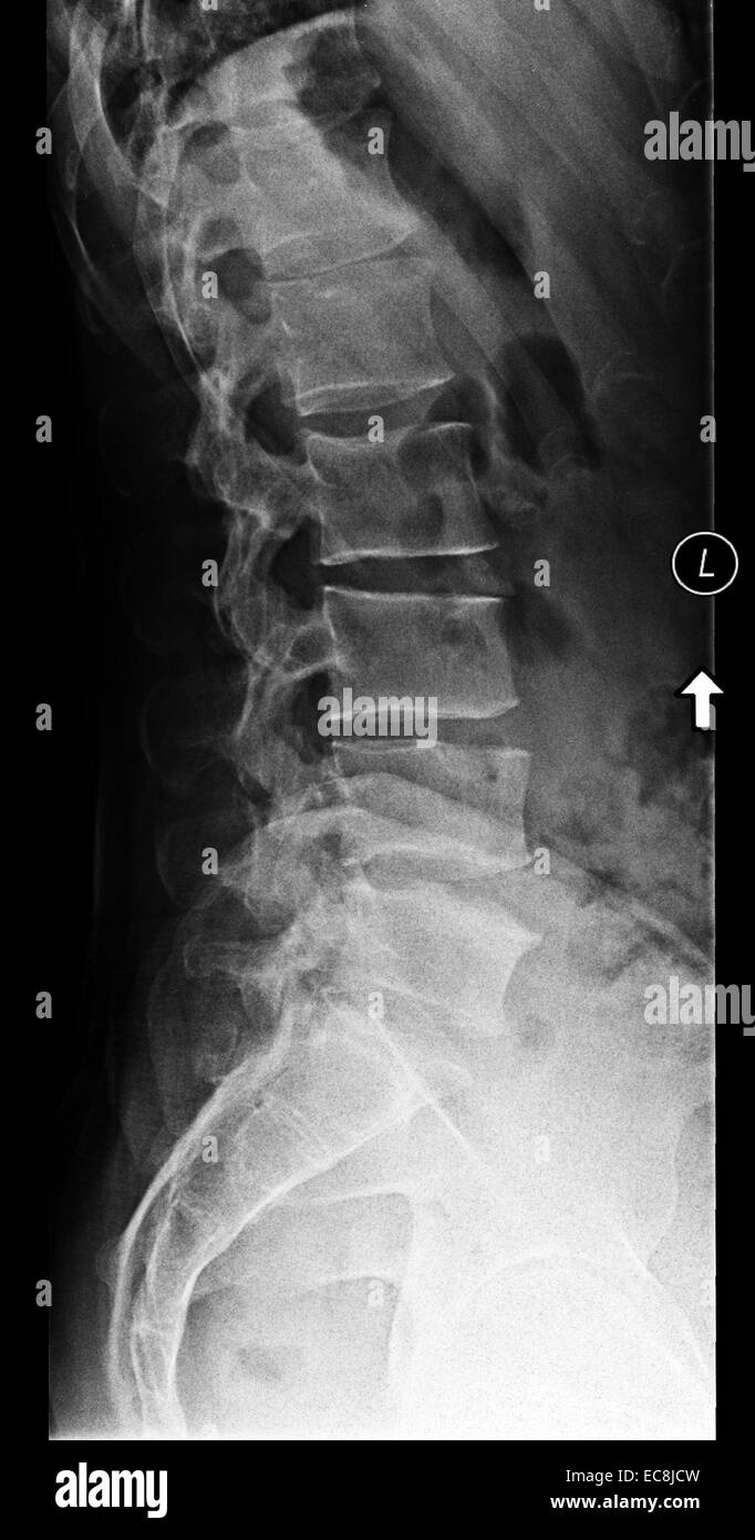 x-ray showing degenerative disc disease at lumbar vertebrae L5-6, lateral view, 40 year old male, subject has one extra lumbar vertebra Stock Photo