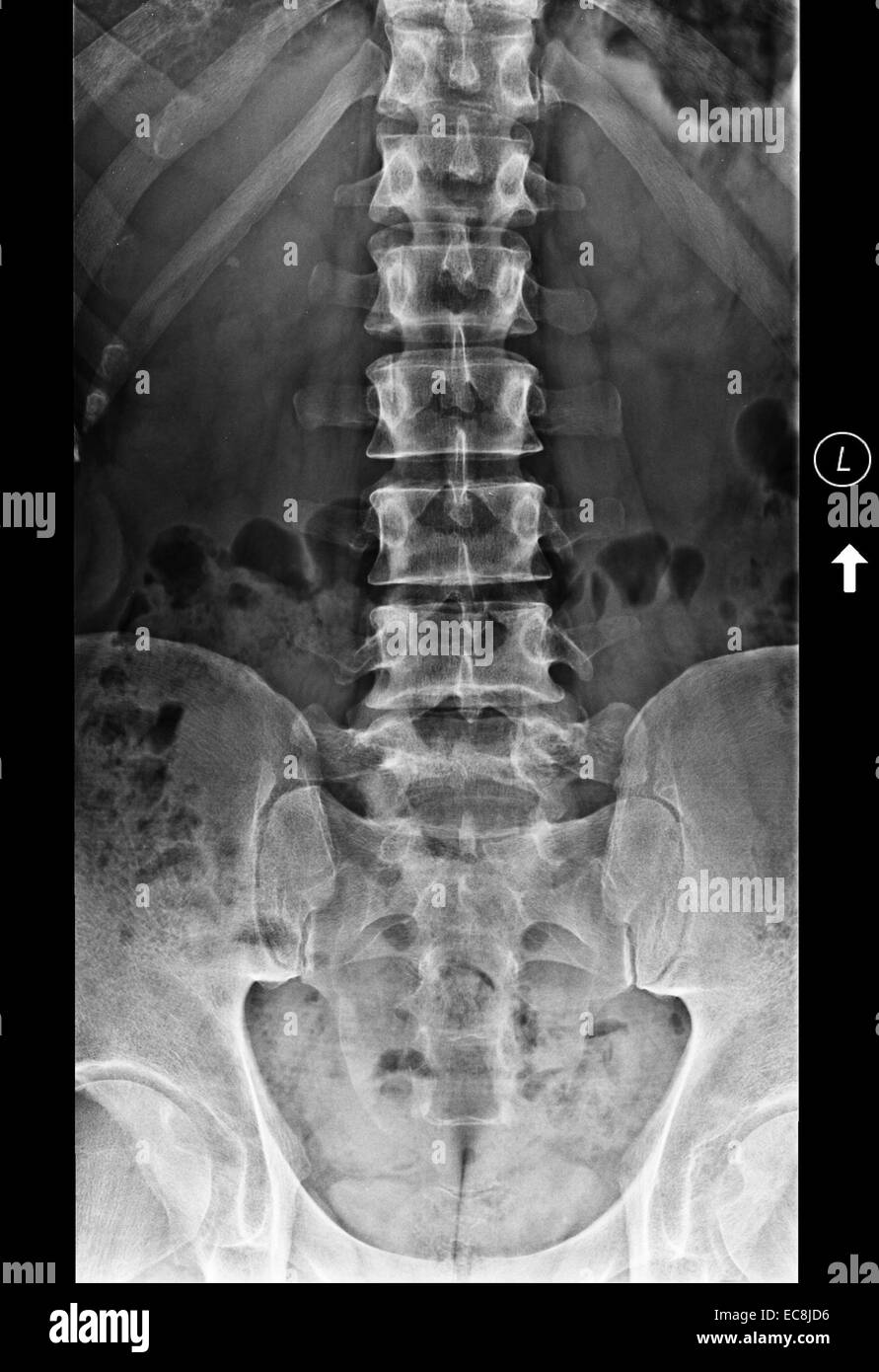 x-ray showing degenerative disc disease at lumbar vertebrae L5-6, medial view, 40 year old male, subject has one extra lumbar vertebra Stock Photo