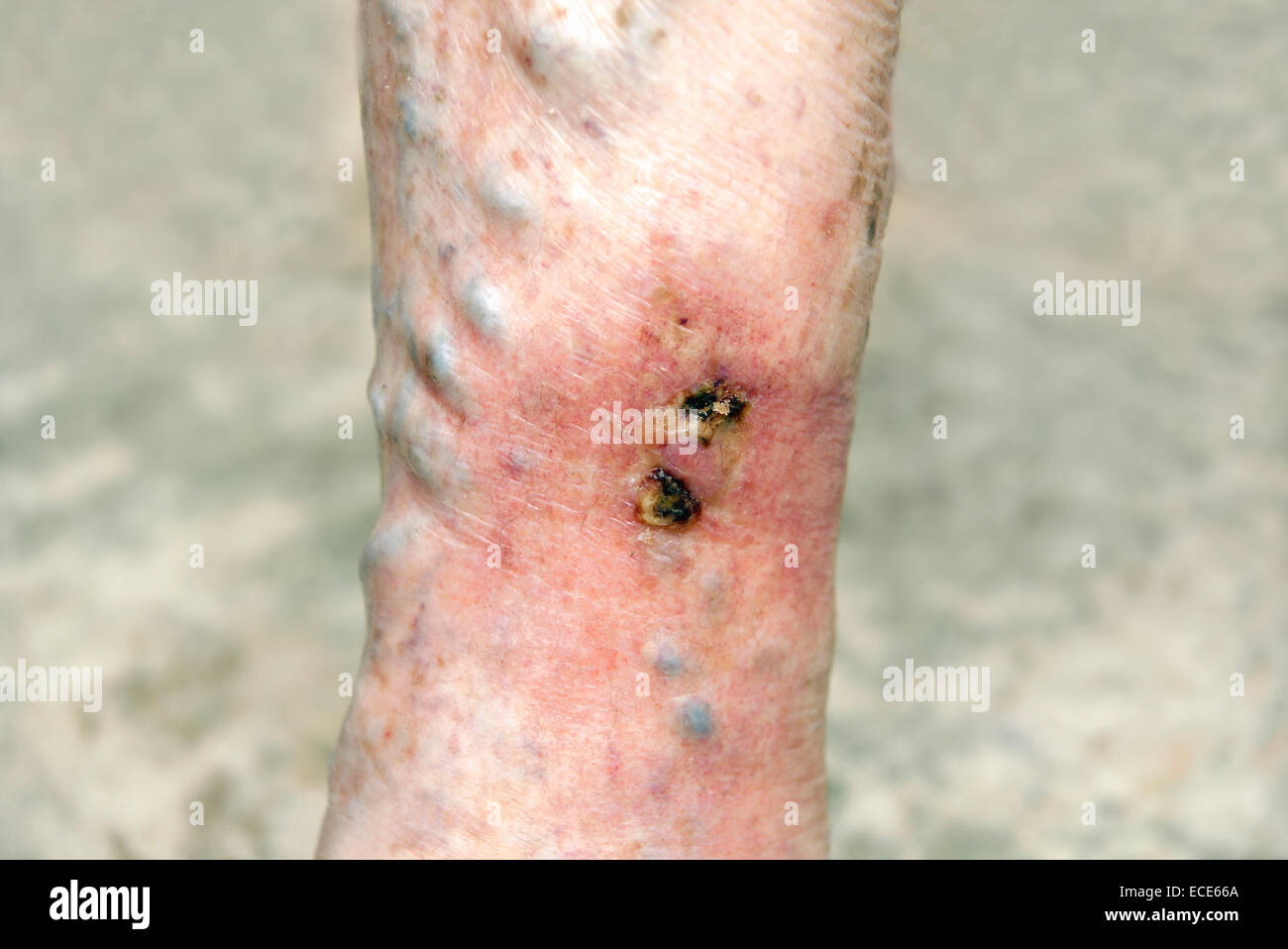 Varicose ulcers situated on a ruptured varicose vein inflamed & very painful Stock Photo