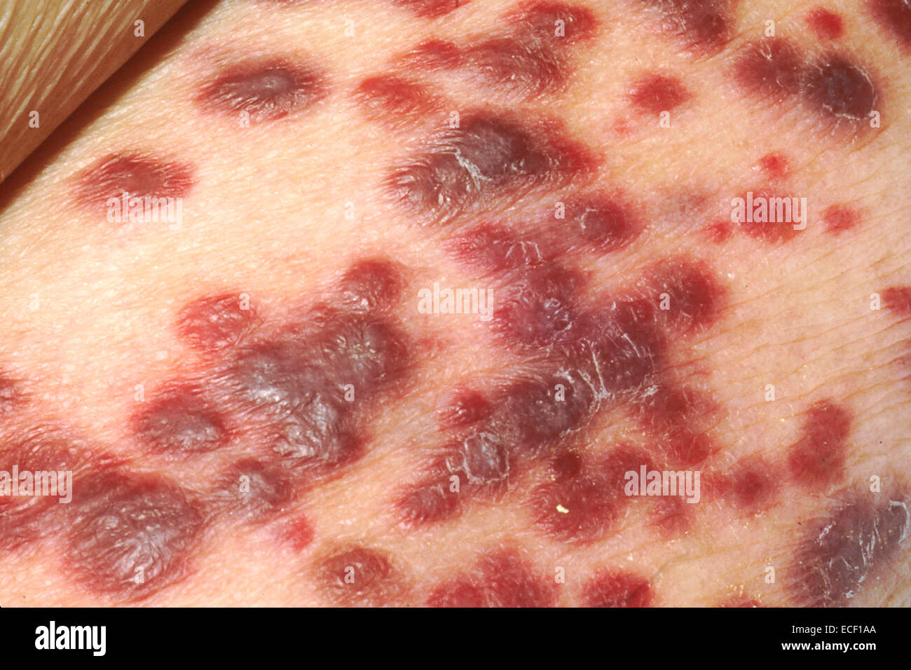 Kaposi's sarcoma on the skin of an AIDS patient. Stock Photo