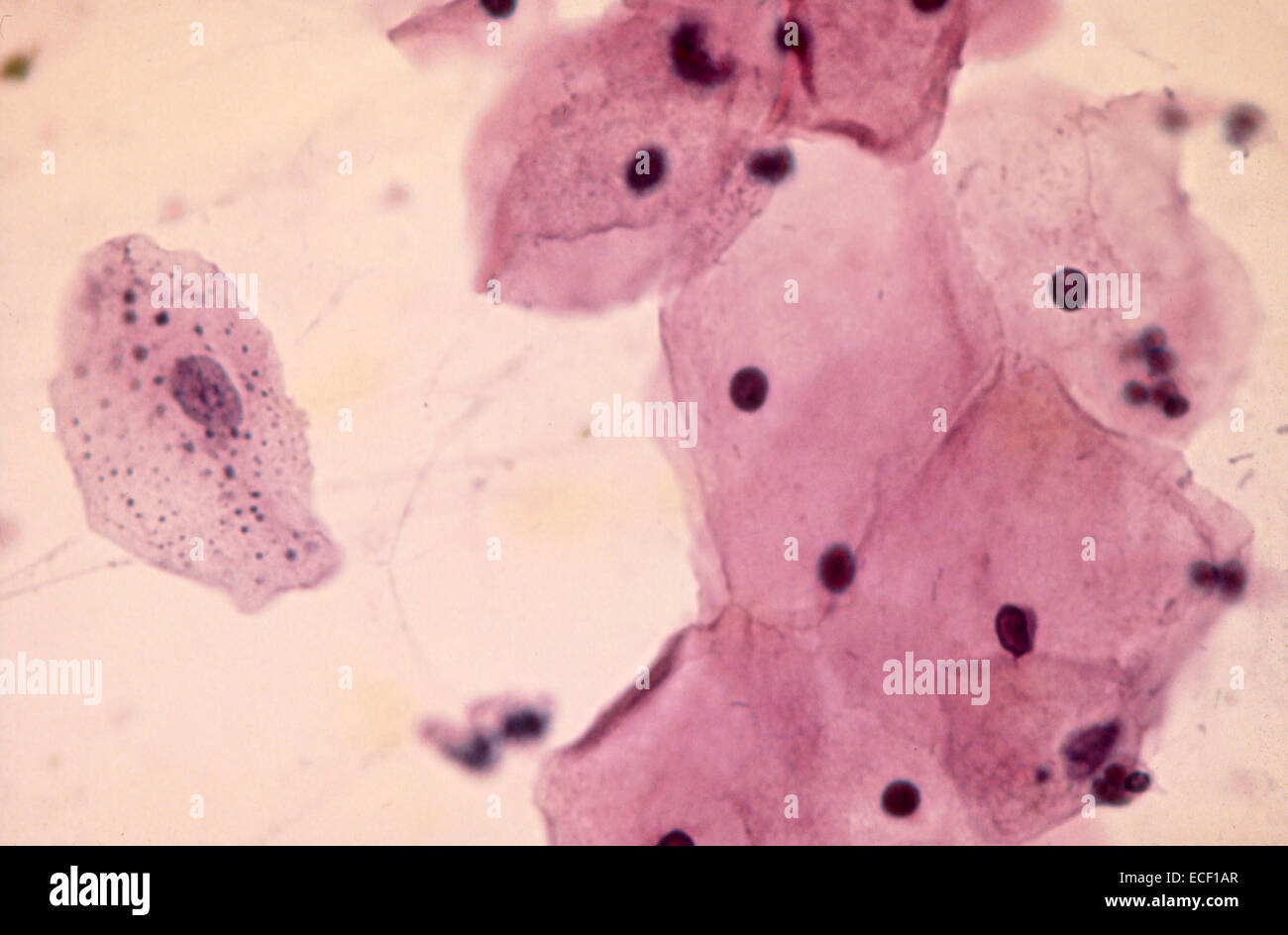 A cytologic smear of vagina with intermediate squamous cells, one of which contains numerous keratohyalin granules (Papanicolaou Stock Photo
