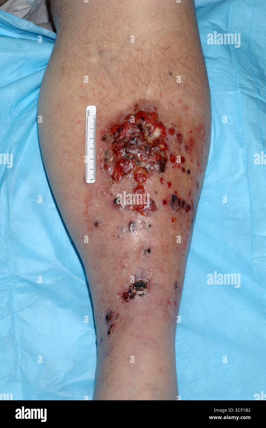 Metastatic Melanoma. Large eroded plaque on the leg with areas of crust. Scattered eroded dermal nodules are also present. Stock Photo