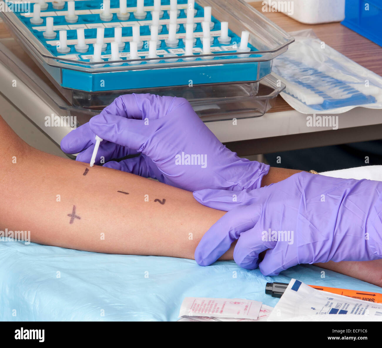 A person receiving a skin prick test (SPT). An SPT is performed by using a needle to place a tiny amount of liquid allergen just Stock Photo