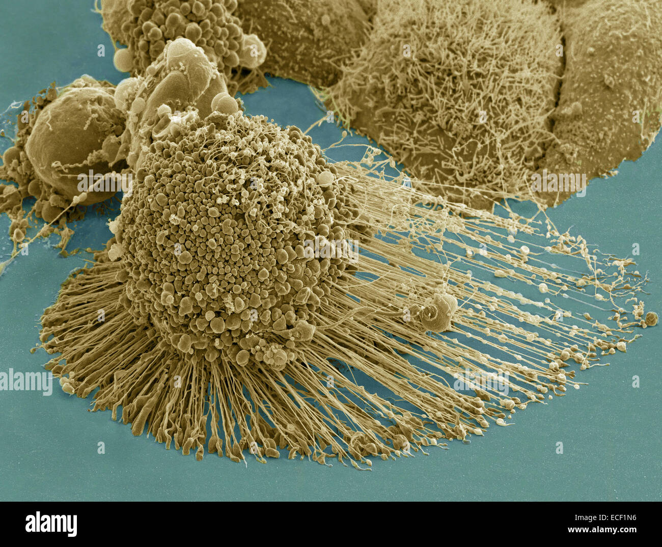 Scanning electron micrograph of an apoptotic HeLa cell. Zeiss Merlin HR-SEM. Stock Photo