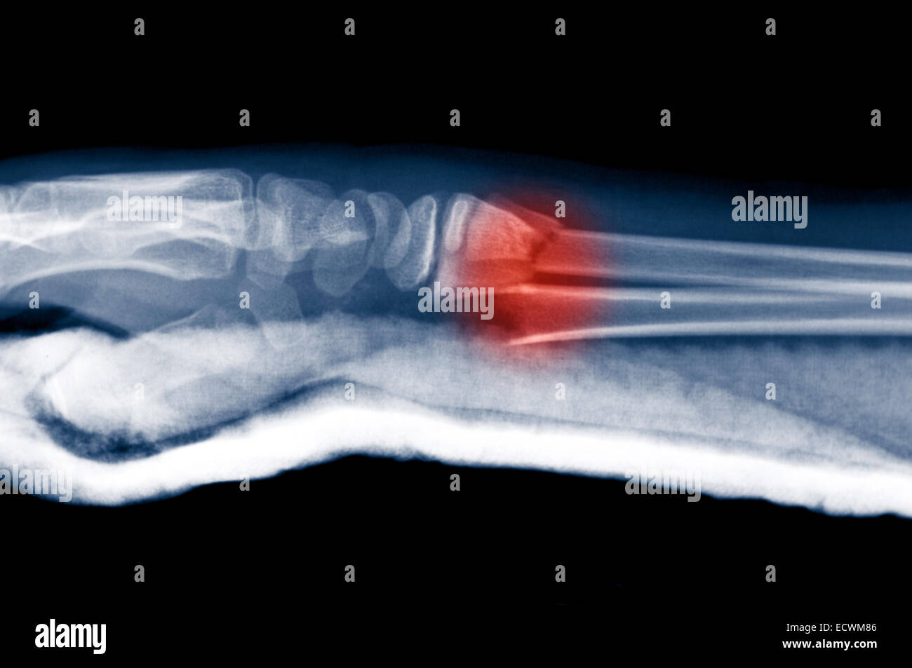 Xray of the forearm showing a fracture Stock Photo Alamy