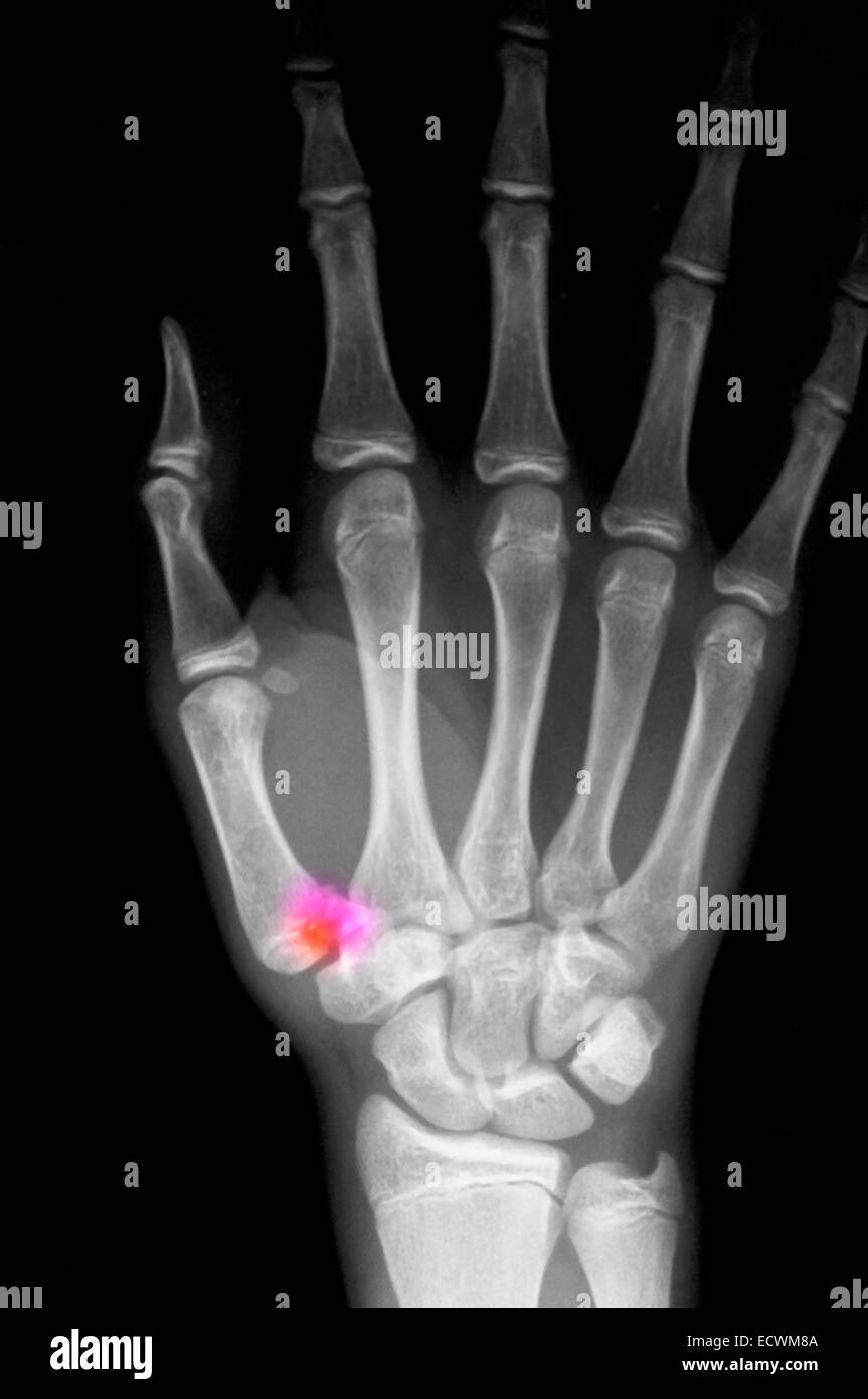 hand x-ray showing a fracture of the thumb metacarpal. Stock Photo