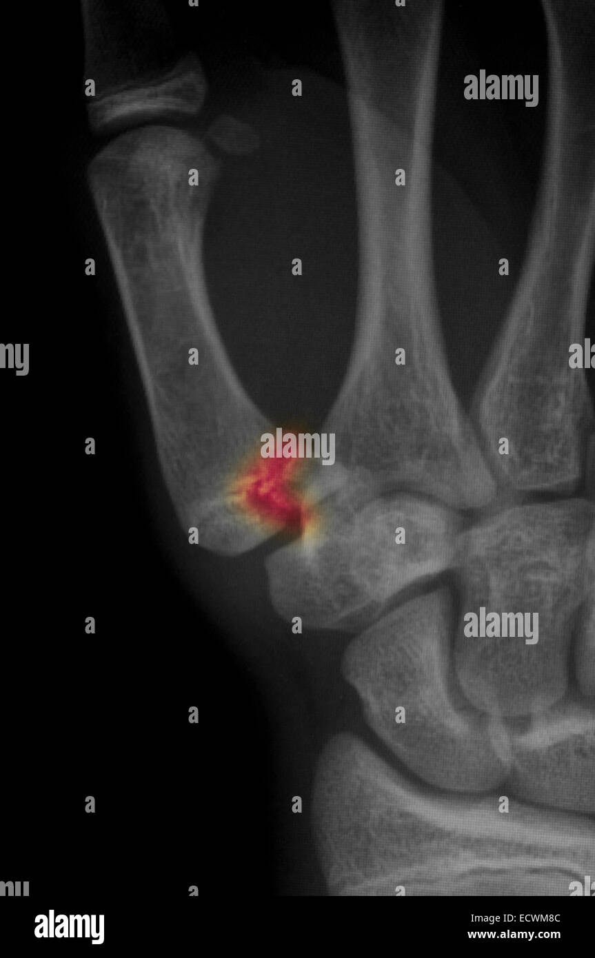 hand xray showing a fracture of the thumb metacarpal Stock Photo Alamy