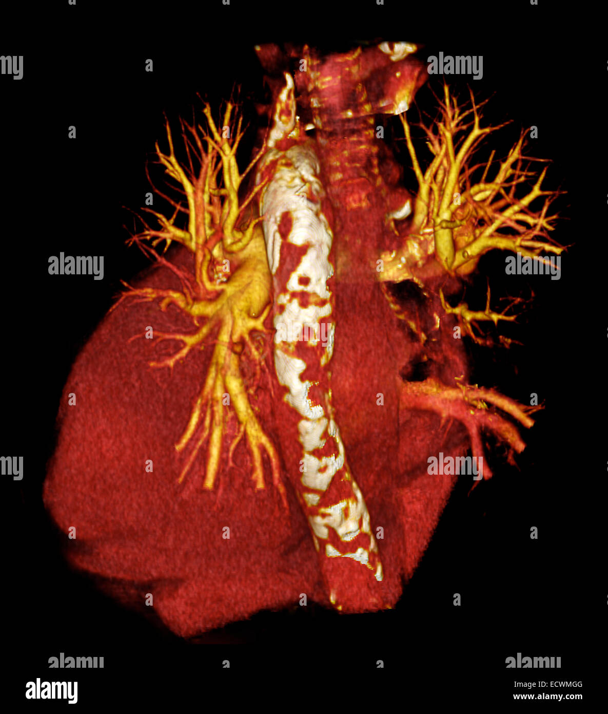 Atherosclerotic calcification of the aorta. Stock Photo