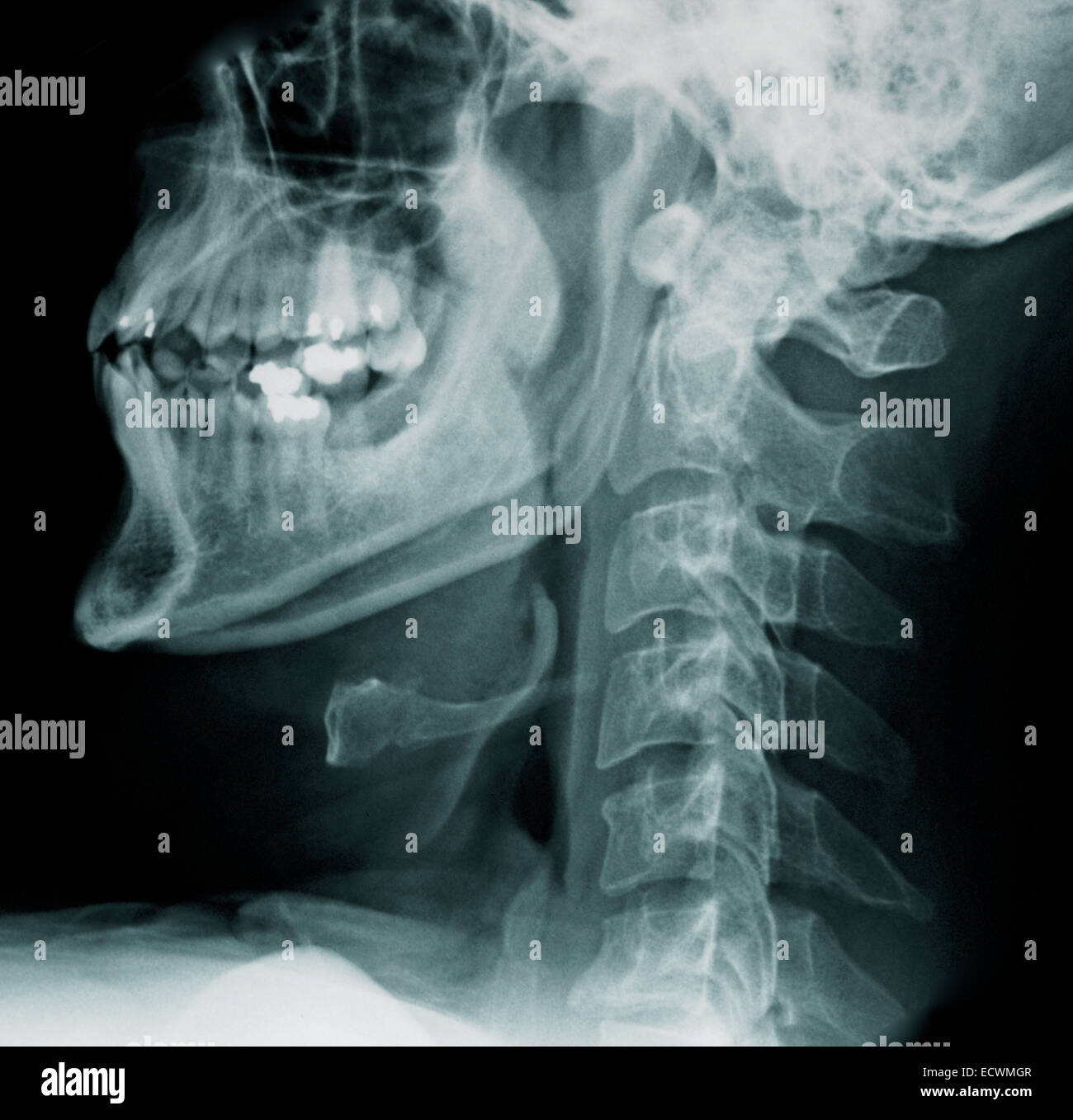 Normal cervical spine x-rays. Stock Photo