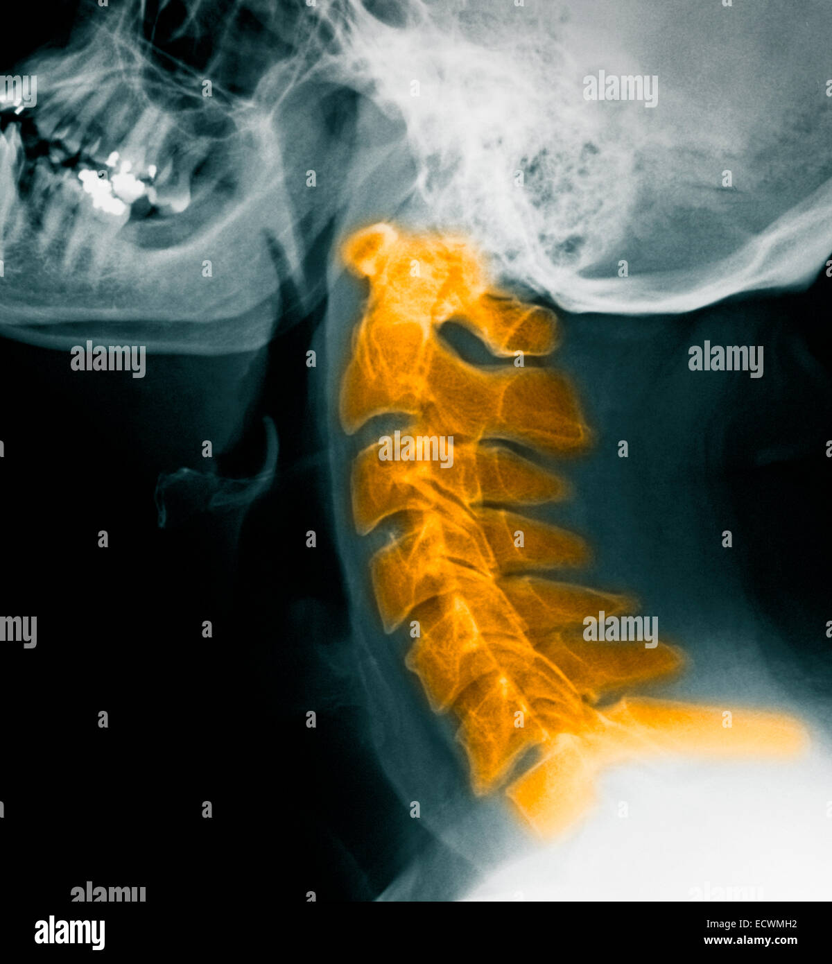 Normal cervical spine x-rays. Stock Photo