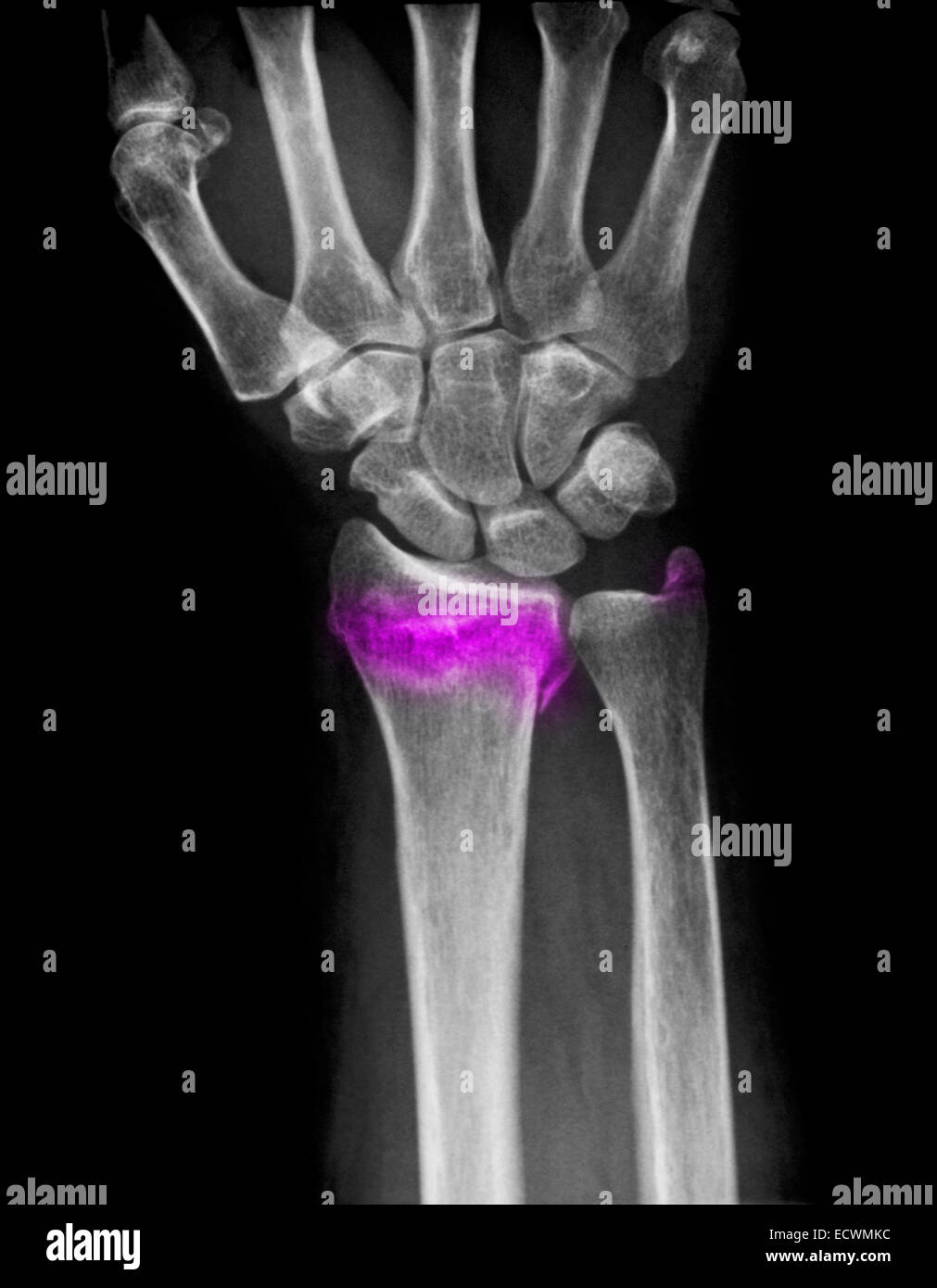 Wrist x-ray showing a fractured distal radius and ulna. Stock Photo