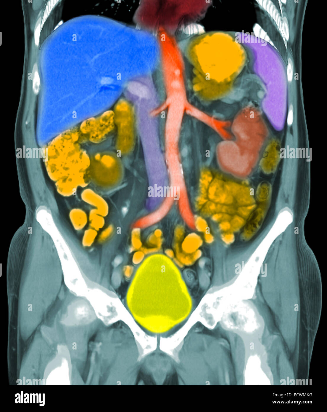 Coronal reconstructions of a CT scan of the abdomen showing metastatic ...