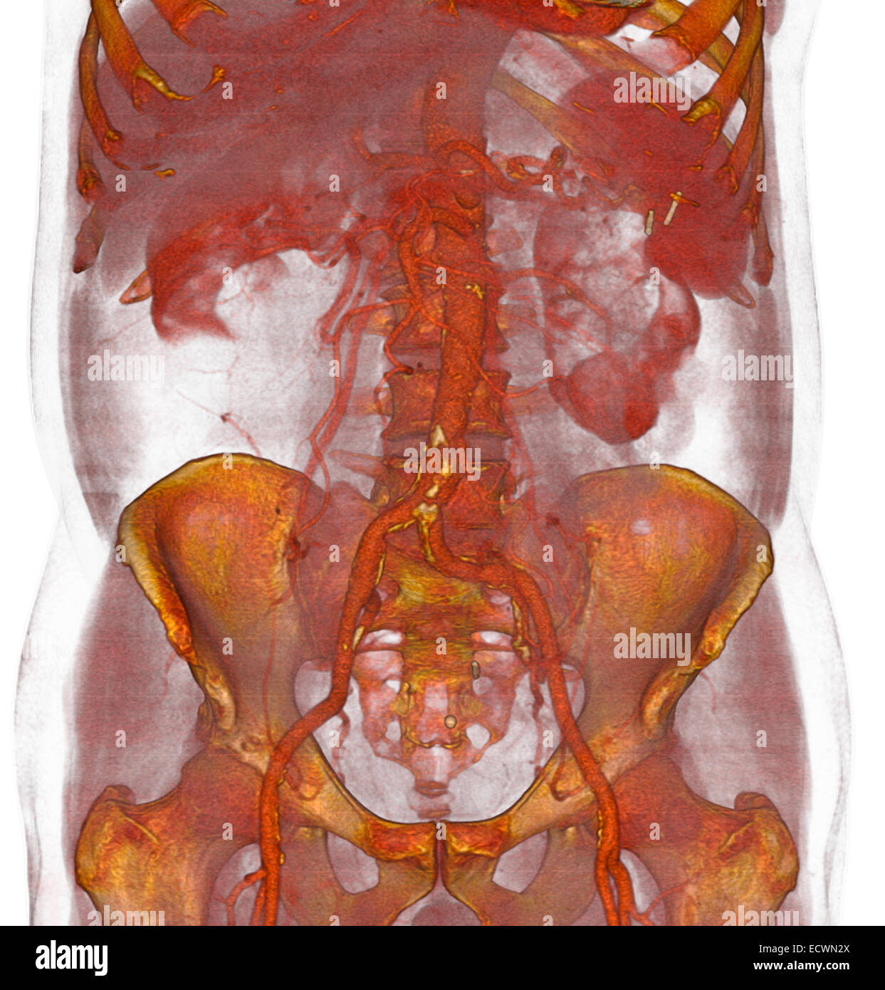 3D CT showing atherosclerotic plaque on the lower aorta. Stock Photo