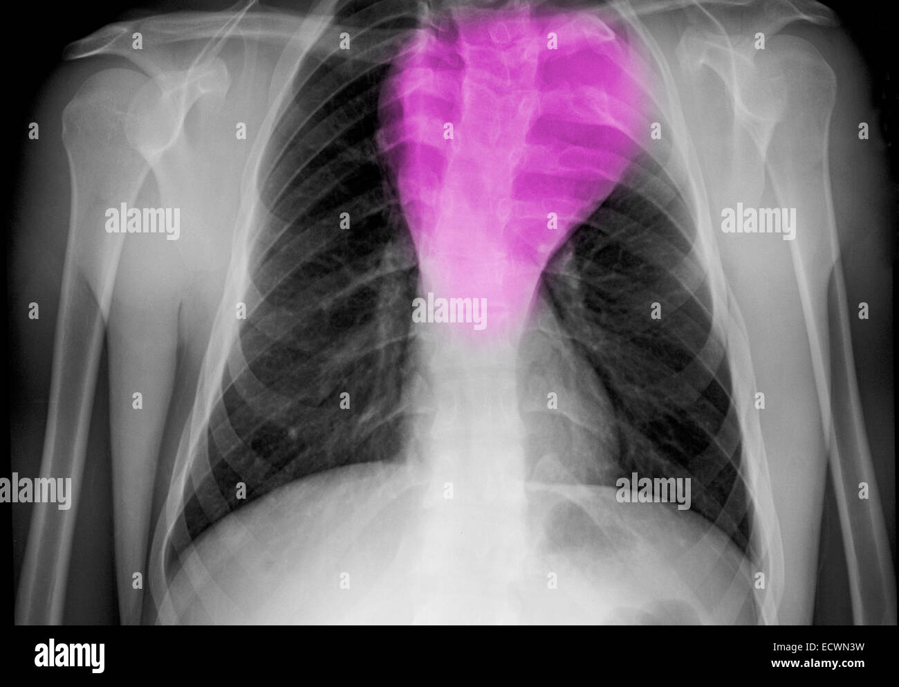 chest x-ray showing a benign chest mass. Stock Photo