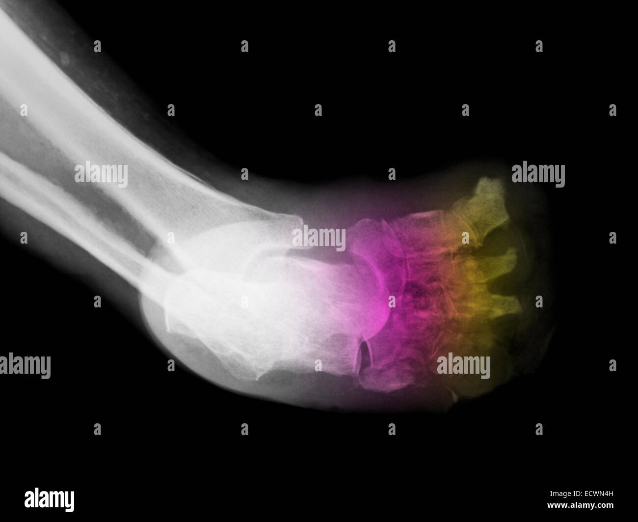 Diabetic foot infection hires stock photography and images Alamy