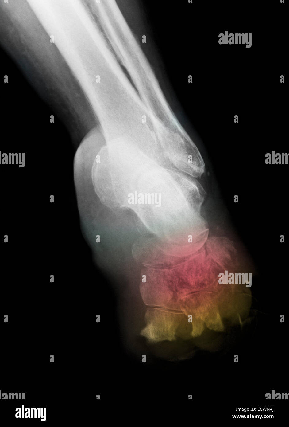 Diabetic foot infection High Resolution Stock Photography and Images Alamy