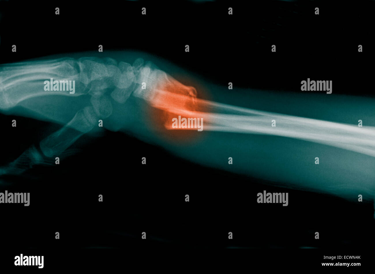 X-ray of the forearm showing a fracture. Stock Photo