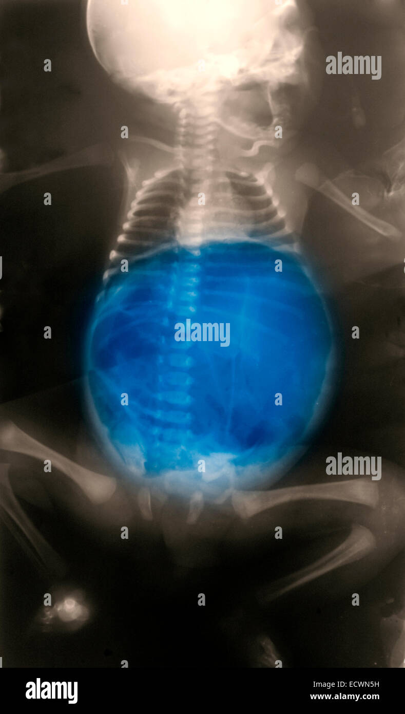 x-ray showing a large amount of gas in the abdomen. Stock Photo