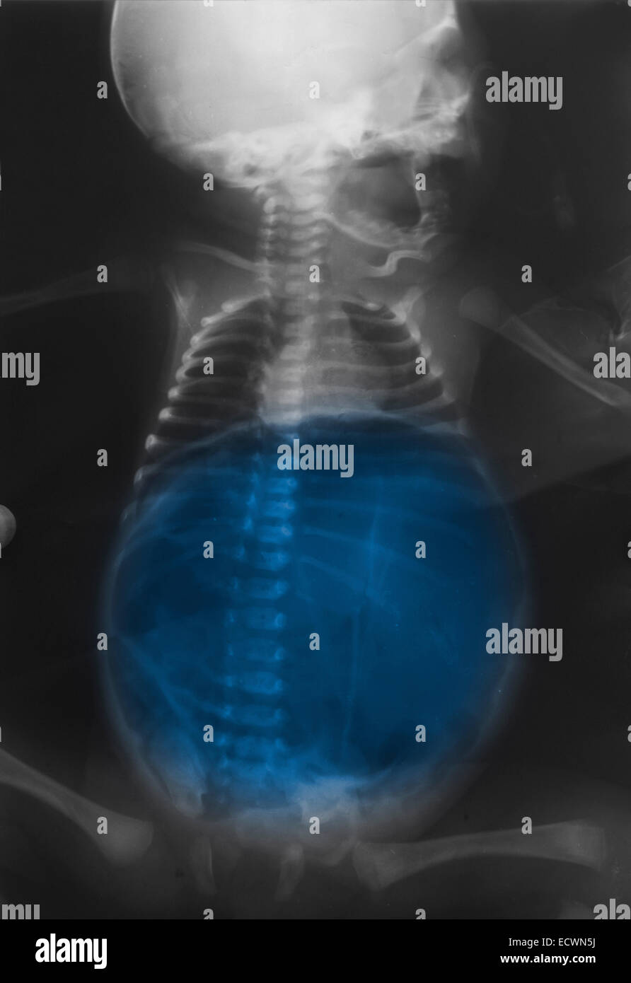 x-ray showing a large amount of gas in the abdomen. Stock Photo