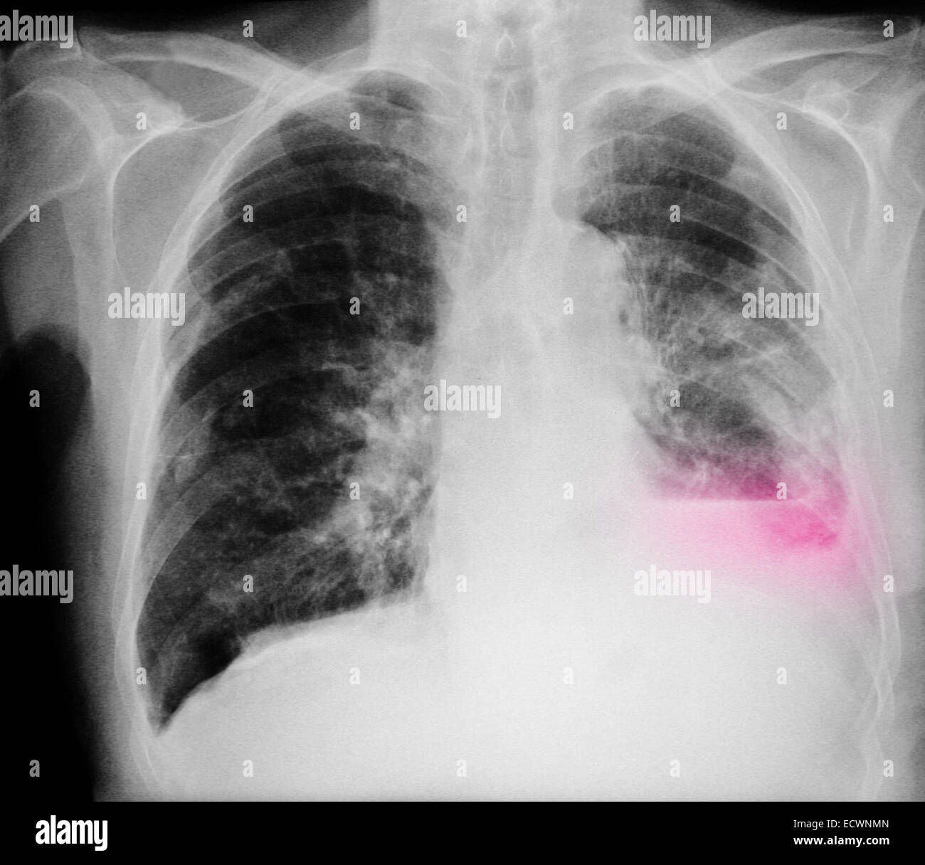 Chest x-ray showing lung cancer and infiltrates Stock Photo - Alamy