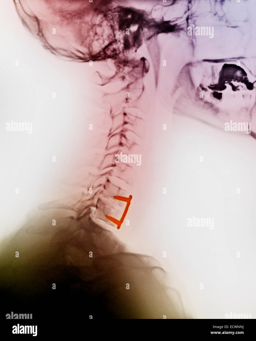 cervical neck x-ray showing spinal fusion. Stock Photo