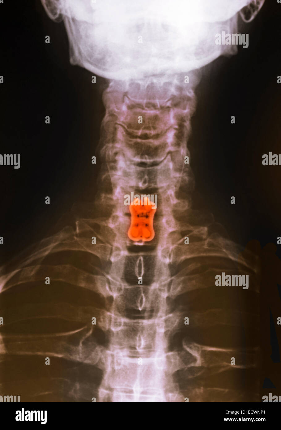 cervical neck x-ray showing spinal fusion. Stock Photo