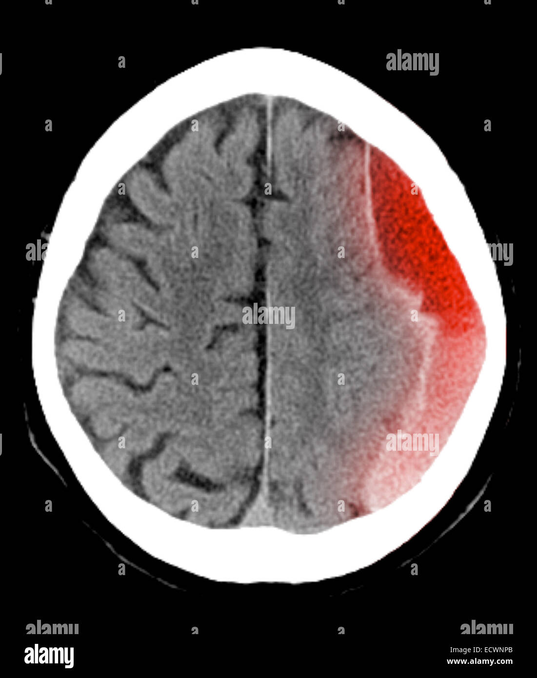 CT scan of the head showing a subdural hematoma. Stock Photo