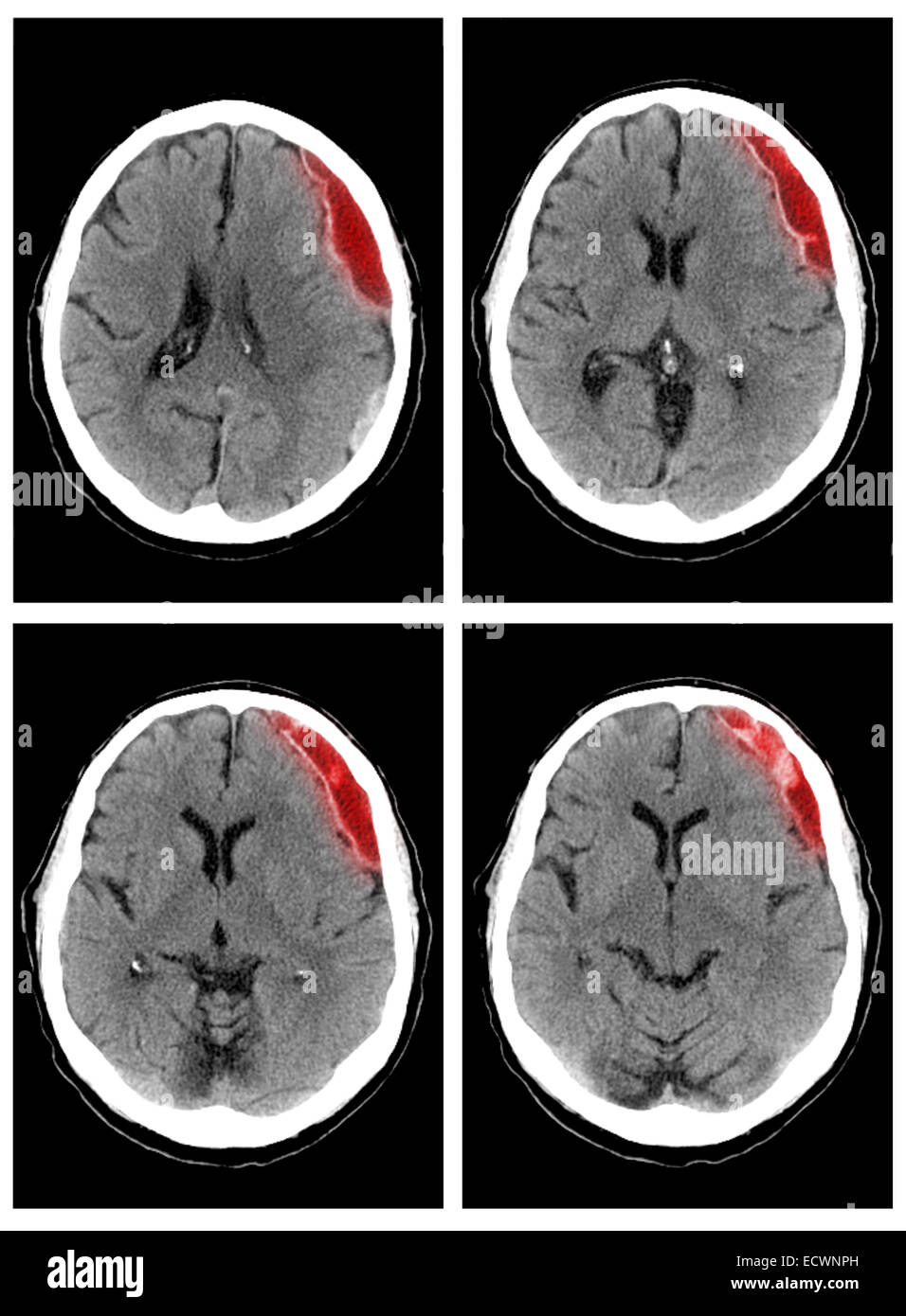 CT scan showing a large left subdural hematoma. Stock Photo