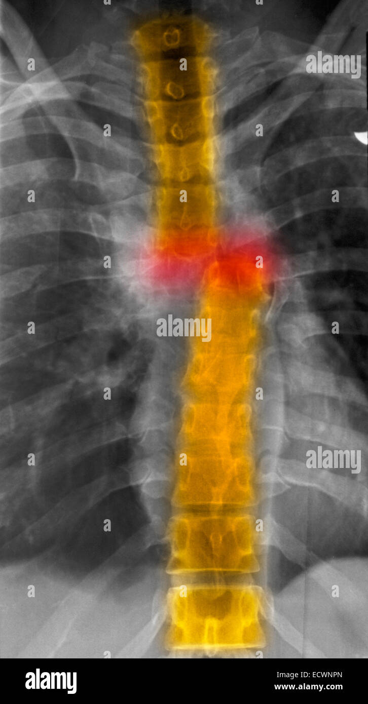 X-ray showing a transection of the thoracic spine Stock Photo