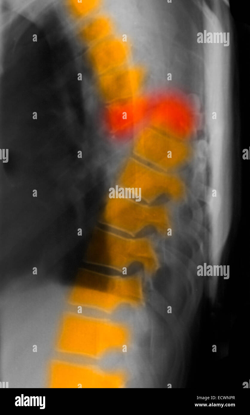 X-ray showing a complete transection of the thoracic spine Stock Photo
