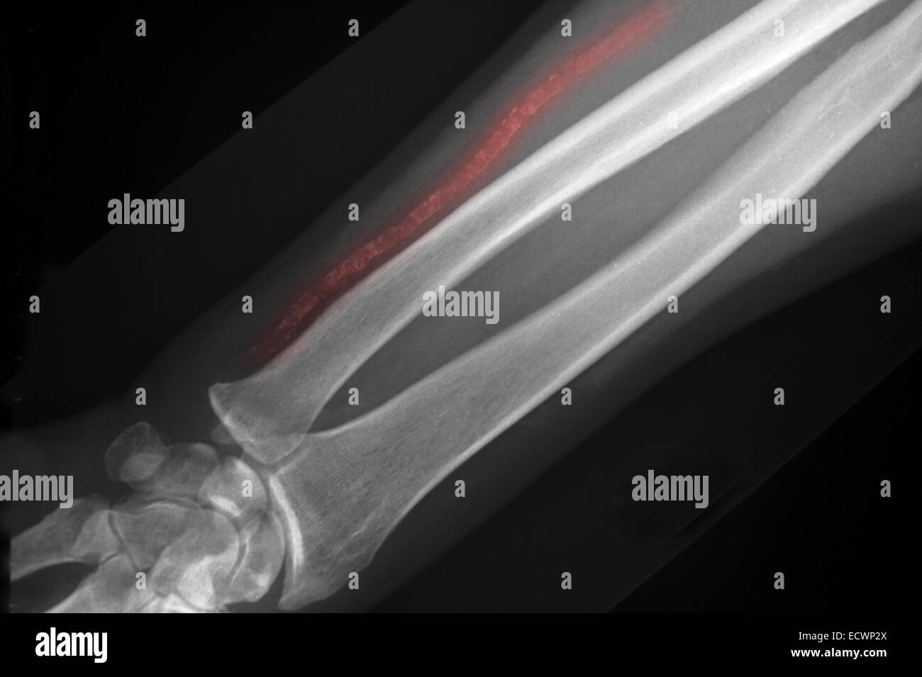 X-ray showing calcification of ulnar artery. Stock Photo