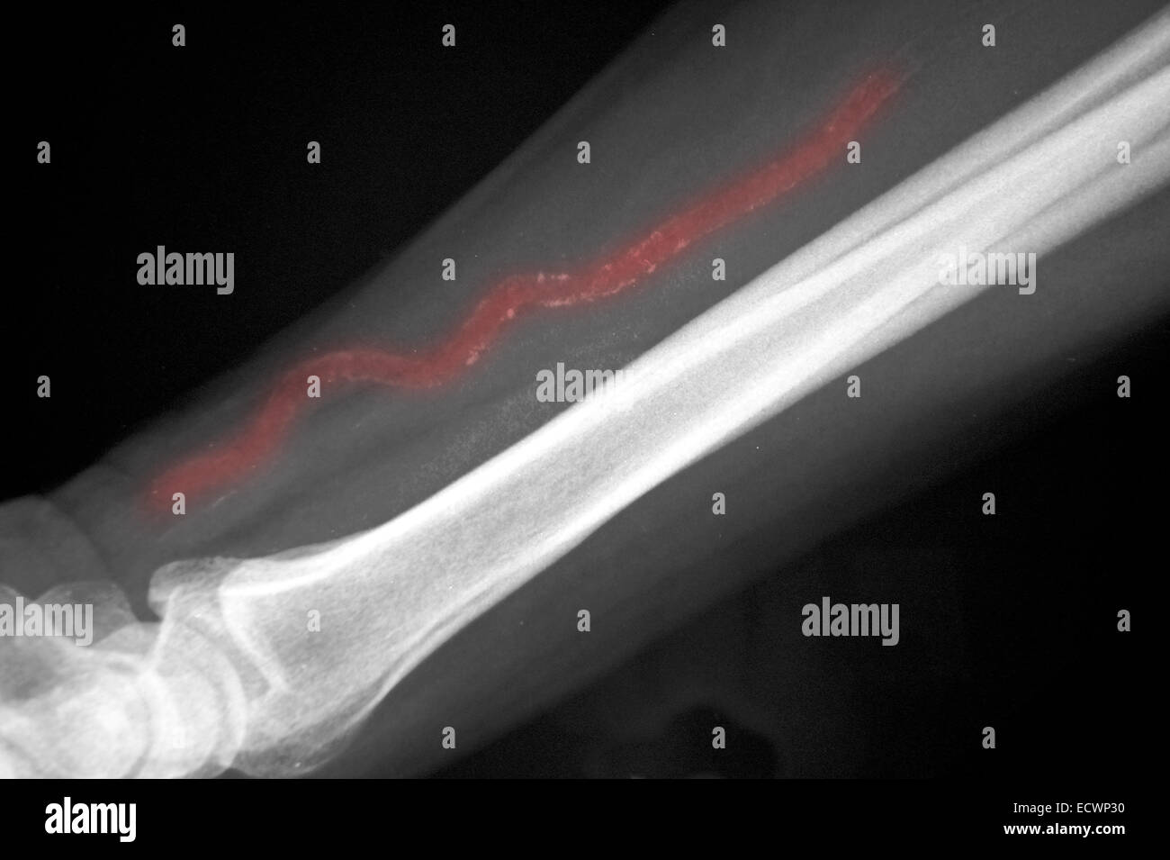 X-ray showing calcification of ulnar artery. Stock Photo