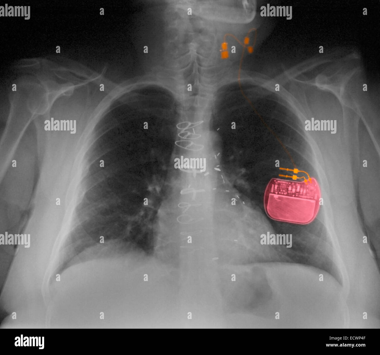 Chest x-ray showing a vagus nerve stimulator for epilepsy. Stock Photo