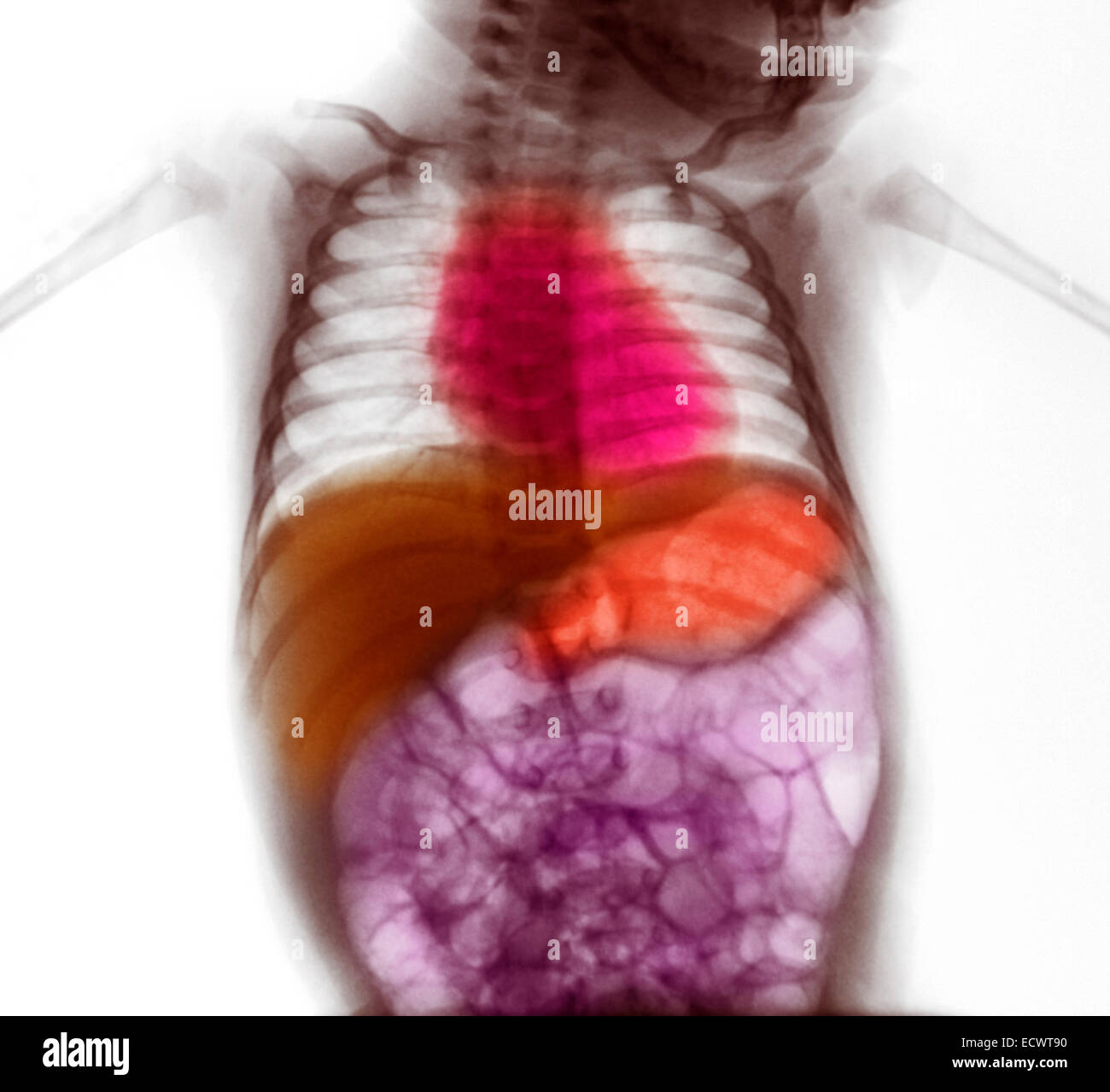 X-ray showing gaseous distension of the intestines. Stock Photo