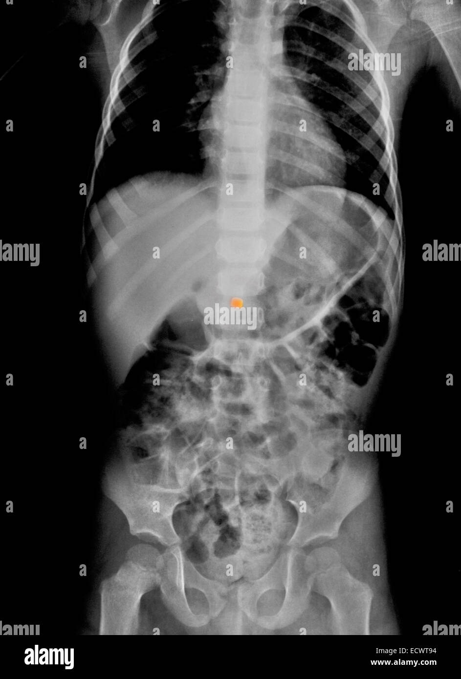 Abdomen x-ray of a boy who swallowed a small metal bead. Stock Photo