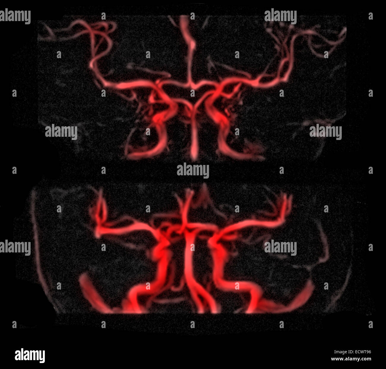 MRI vascular brain radiographic study. Stock Photo