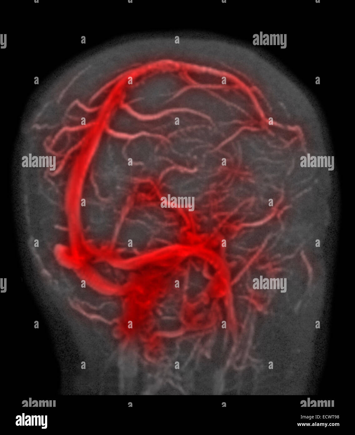 Normal MRI study of the brain. Stock Photo