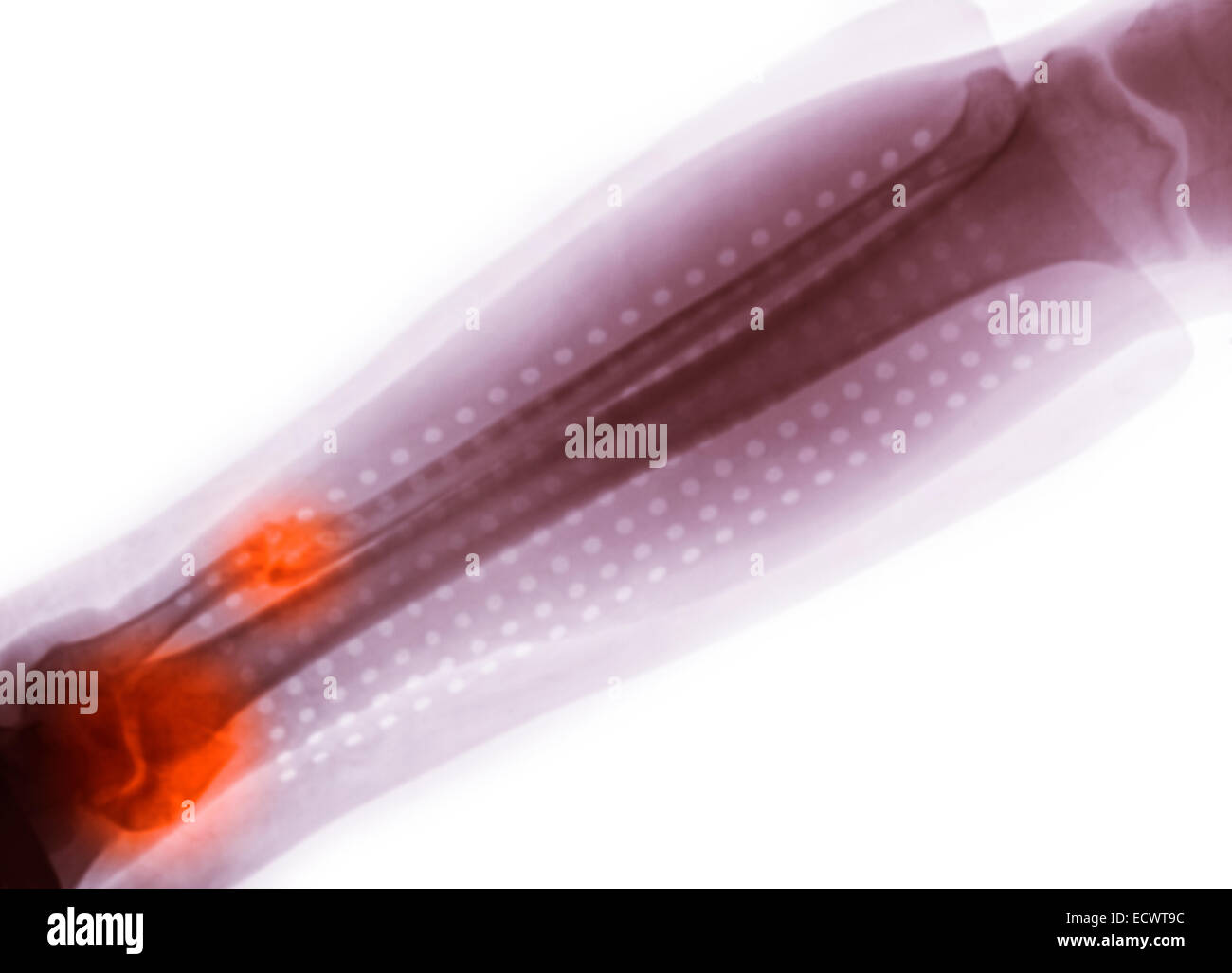 X-ray showing an ankle fracture. Stock Photo