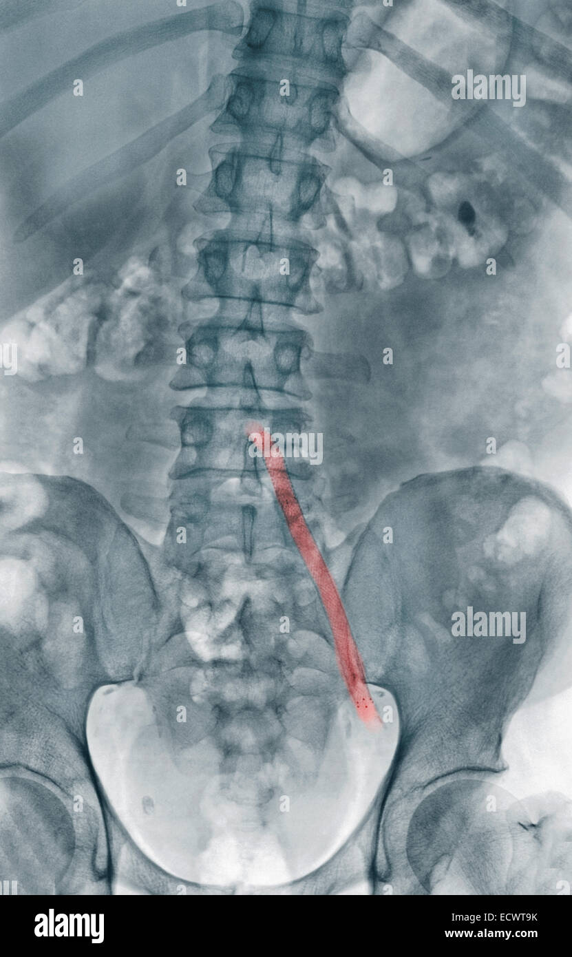 X-ray showing an aorto-iliac wire-mesh bypass graft. Stock Photo