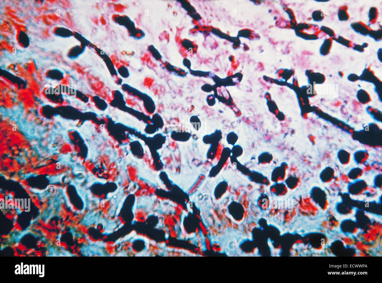 Histopathology of mucosal infection caused by Candida fungi. Stock Photo