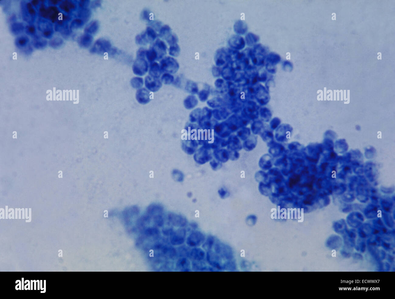 Gram stained micrograph of pulmonary candidiasis Stock Photo