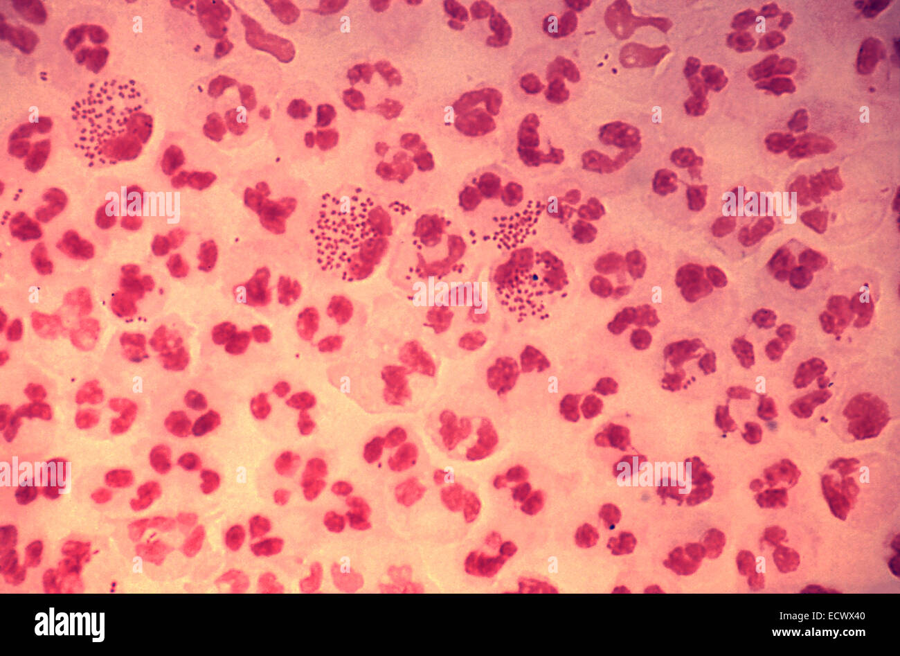 Histopathology of gonococcal urethritis. Stock Photo