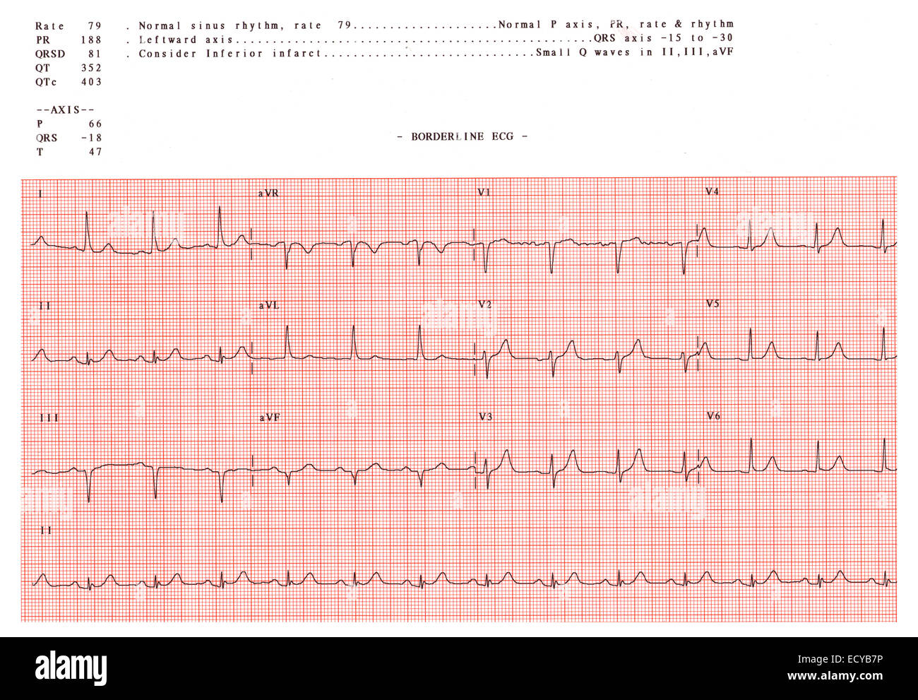 Normal Sinus Rhythm High Resolution Stock Photography And Images Alamy Normal Sinus Rhythm High Resolution Stock Photography And Images Alamy