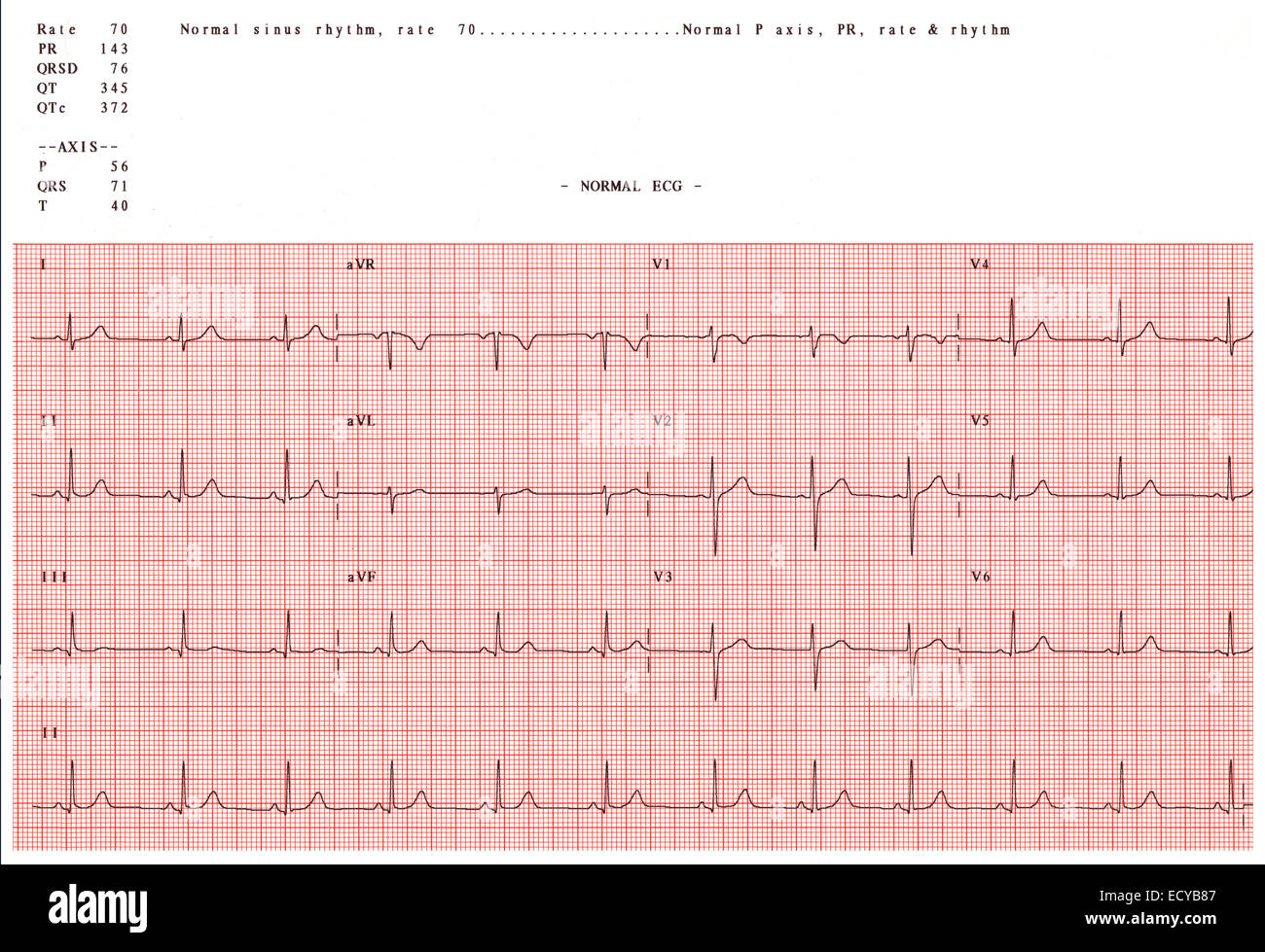 Normal electrocardiogram. Stock Photo