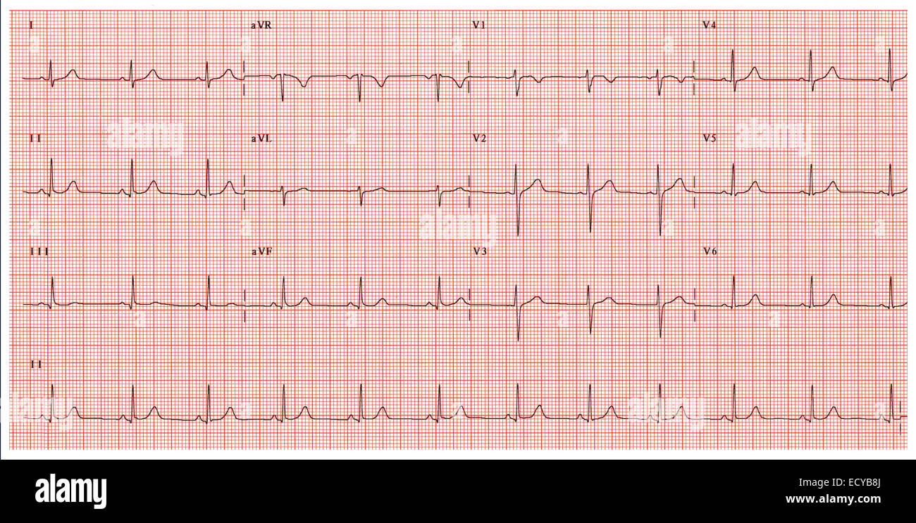 Normal electrocardiogram. Stock Photo