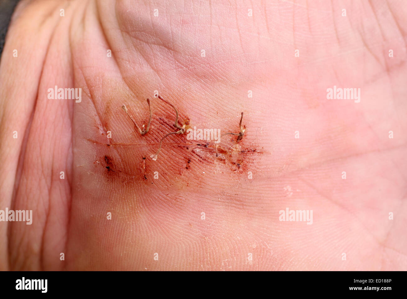 October 2008 - Close in near Macro of post operation scaring following an operation for Carpel Tunnel surgery Stock Photo