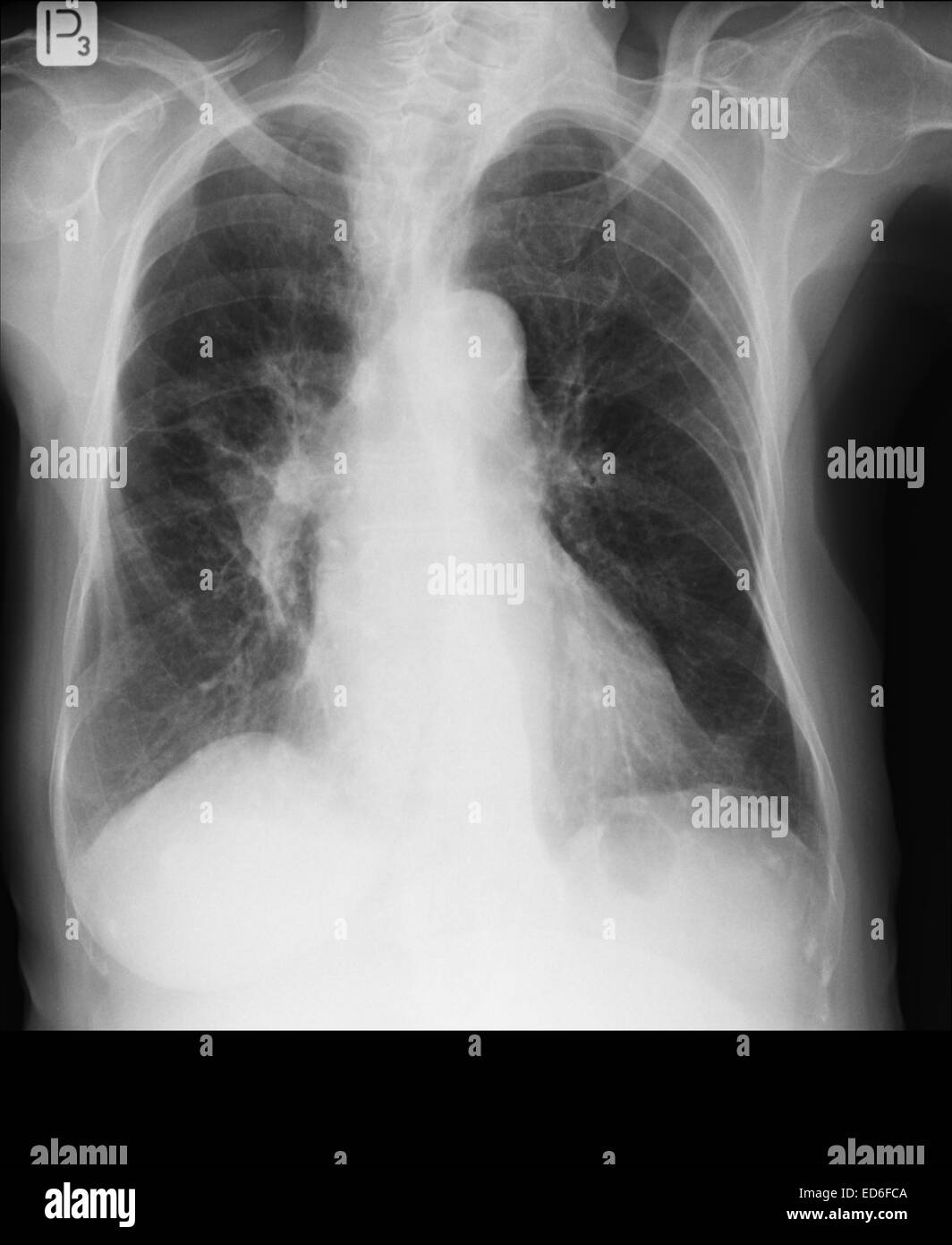 Chest xrays during lungs Tuberculosis also called as MTB or TB of